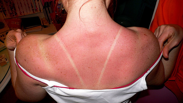 sunburn